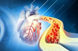 Hypercholestérolémie : la cause génétique prédit mieux les risques cardiovasculaires