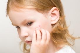 La « 5ème maladie », un virus qui touche essentiellement les enfants 