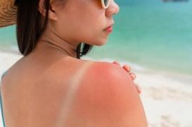 Empoisonnement au soleil ou coup de soleil : comment faire la différence ?