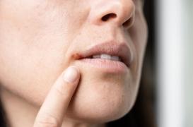 Herpès labial : 5 choses à ne surtout pas faire quand on a un bouton de fièvre