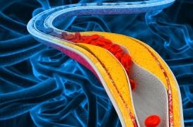 Athérosclérose : et si c’était la faute des gènes ?