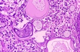 Angiofibrome : un parasite aurait provoqué une tumeur massive sur sa paupière