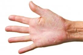 Psoriasis : un escape game pour sensibiliser le grand public à la maladie