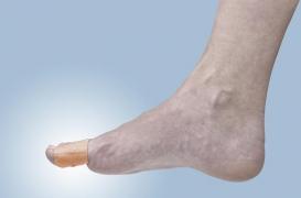 Rhumatismes : que manger pour éviter les crises de goutte ?