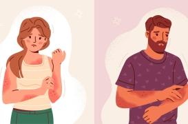 Eczéma : 12 préjugés à oublier sur cette maladie cutanée chronique 