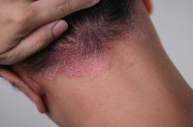 Psoriasis : un déséquilibre hormonal du fer dans la peau en cause ?