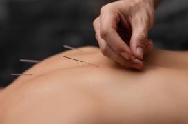 L'acupuncture réduit la douleur de la sciatique chronique due à une hernie discale