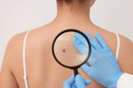 Grain de beauté et mélanome : pourquoi le soleil n’est pas le seul risque