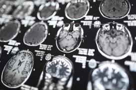 SLA : le rôle clé d’une protéine découvert dans la maladie de Charcot