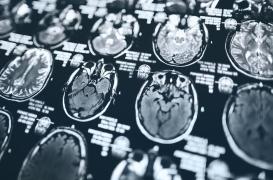 Toux : des cellules réagissent à l’eau présente dans les poumons en cas de fausse route