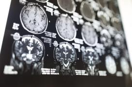 Hyperthymésie : une adolescente possède une mémoire autobiographique hors normes