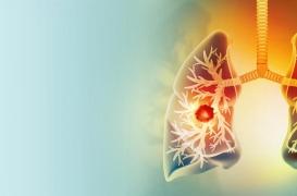 Cancer du poumon : quel impact sur la mortalité des femmes en Europe ?