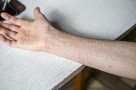 Rougeole : le bilan 2025 dépasse déjà celui de 2024 