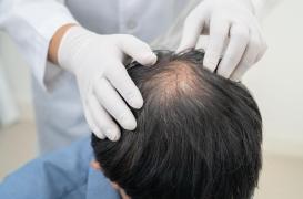Analogues du GLP-1 : un effet inattendu sur les cheveux ?