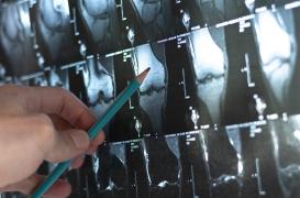 Ostéoporose : cet aliment consommé durant les fêtes aide à lutter contre cette maladie