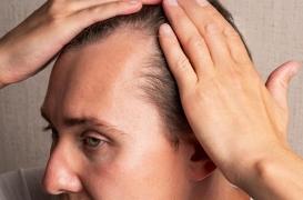 Alopécie : une attestation sera bientôt nécessaire pour obtenir ce médicament 