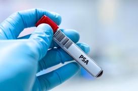 Dépistage du cancer de la prostate : une baisse des décès enfin confirmée ?
