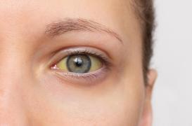 Cancer du pancréas : ce signe n'est pas forcément un symptôme de la maladie