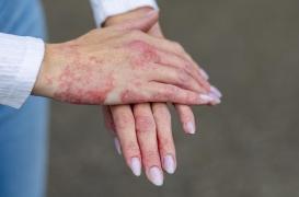 Eczéma : comment le stress déclenche les poussées ? 