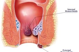 Hémorroïdes externes : 4 conseils pour éviter les récidives 
