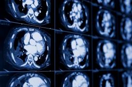 Cancer du rein métastatique : un nouveau standard de traitement