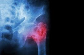 Ostéoporose : les traitements sont-ils mauvais pour les dents ?