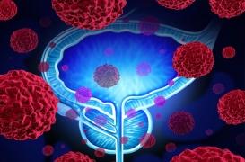 Cancer de la prostate : la cryoablation fait ses preuves