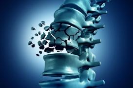 Une jeune patiente porte plainte contre le médecin de sa mère : qu’est-ce que la spina bifida ? 