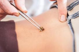Maladie de Lyme : elle se fait piquer par des abeilles puis voit ses symptômes disparaître