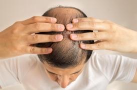 Manger trop gras accélère la chute de cheveux