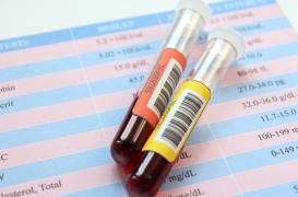 Cholestérol : 4 conseils de cardiologue pour réduire les mauvaises graisses