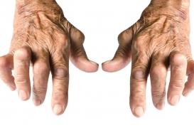 Une mortalité cardiovasculaire plus élevée chez les patients atteints d’arthrose