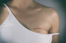 Cancer du sein : cette carence augmente les douleurs post-chirurgicales
