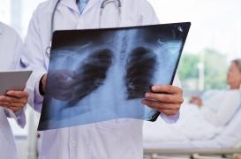 Coronavirus : un jeune infecté sur quatre développe une pneumonie