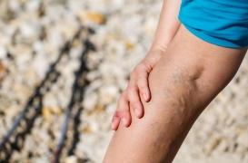 Varices des jambes : ces symptômes à ne pas négliger 