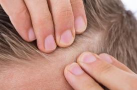 Des scientifiques stimulent la repousse des cheveux sur une peau abîmée