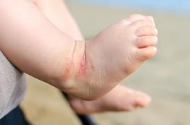 Dermatite atopique : elle augmenterait le risque de fractures chez l'enfant
