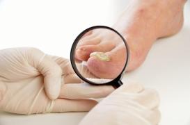 Onychomycose : 4 facteurs augmentant vos risques d'infection fongique des ongles