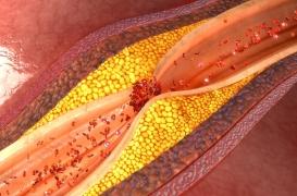 Athérosclérose : comment prévenir le risque d’artères obstruées ? 