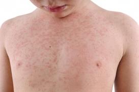 Rougeole : une amende pour les parents qui ne vaccinent pas leur enfant ?