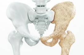 Une nouvelle molécule prévient les lésions de l’os provoquées par les corticoïdes 