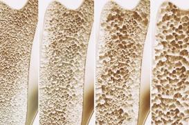 Ostéoporose : la douleur et la fatigue sont-elles révélatrices de la maladie ?