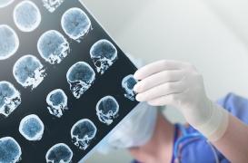 Il n'existerait pas une seule maladie d'Alzheimer, mais plusieurs