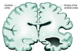 Alzheimer : la maladie s'installe chez les patients beaucoup plus tôt que ce que l'on pensait