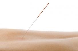 Acupuncture : les médecins discutent de la prescrire dans la douleur chronique