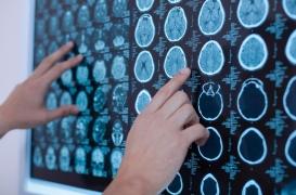 Quatre ans après son retour d’Inde, elle découvre 38 larves de parasite dans son cerveau