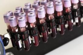 Cancer du sang : un traitement révolutionnaire au CHU de Rennes