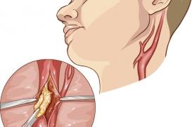 Patient hors norme : des chirurgiens découvrent deux veines jugulaires au lieu d'une