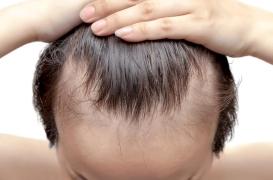 Perte de cheveux : peut-on encore prendre ce médicament sans risque ?