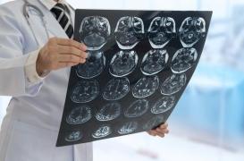 Les commotions ont un impact durable sur l’activité cérébrale des jeunes adultes